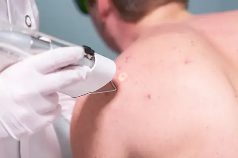 Huidoneffenheden bij Dermavita Huidtherapie Zaandam